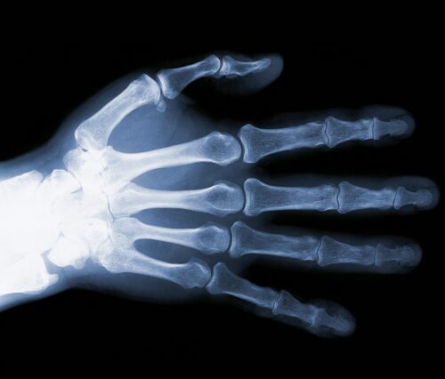 Hand genomlyst med röntgen så att man bara ser skelettet. 