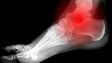 Fot genomlyst av röntgen så att man ser skelettet. Bakre foten är rödmarkerad för att påvisa smärta. 